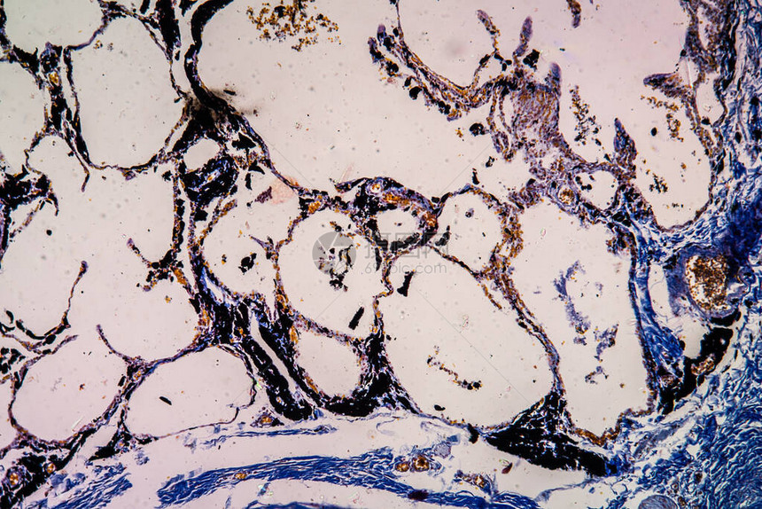 显微镜下的炭粉尘肺组图片
