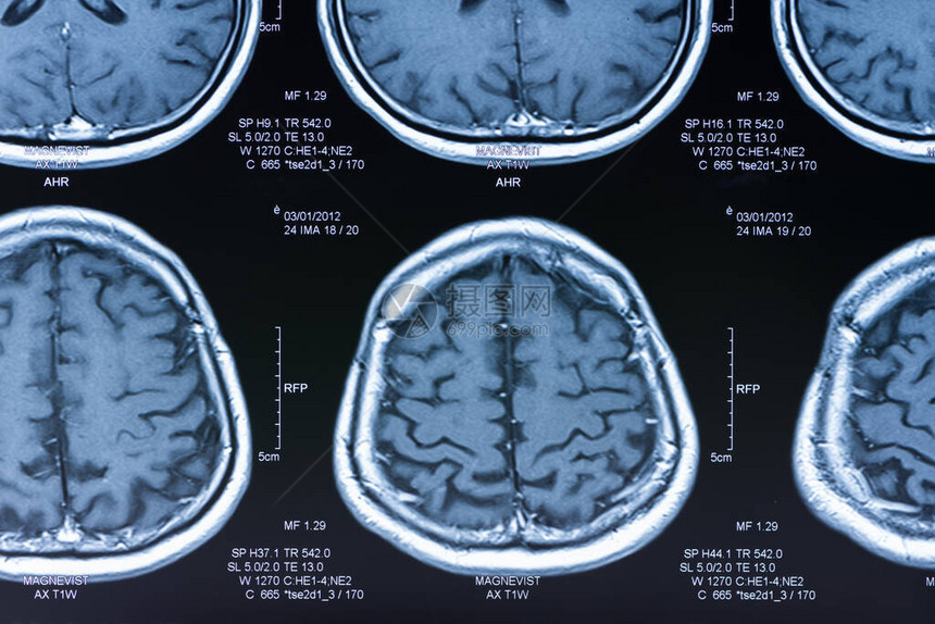 Ct扫描的脑部图片