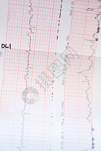婴儿出生前的心电图图片
