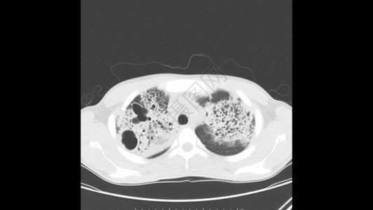 一名已知的肺结核活病患者胸口肺窗轴心色分析图片