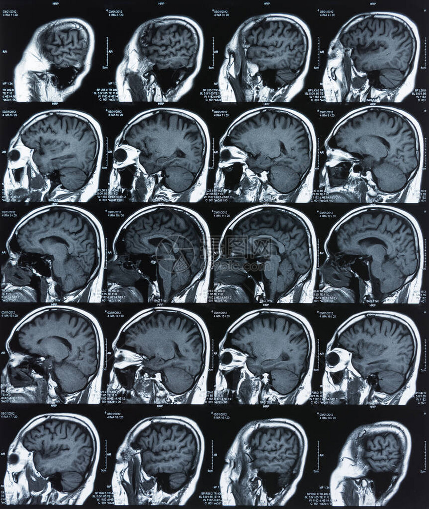 脑部X光胶片图像由MriCt扫描图片