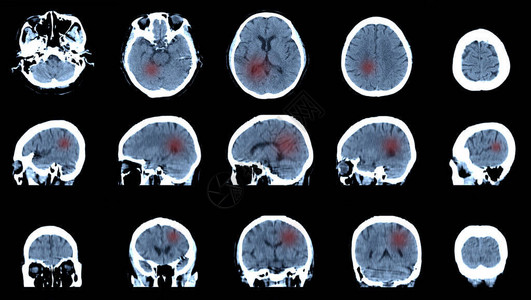 MRI脑部扫描脑射线日冕横反图像图片