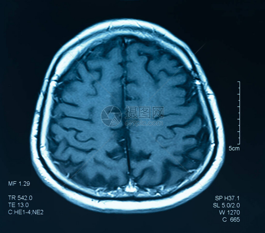 磁共振图像大脑的mri扫描图片