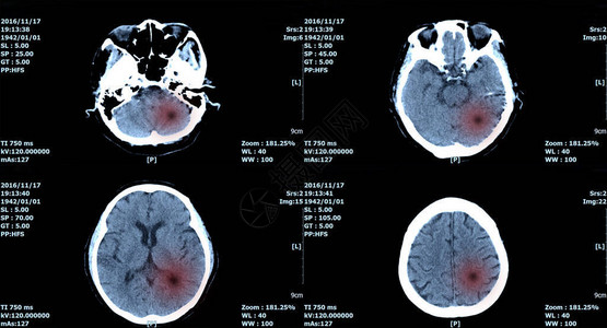 核磁共振扫描脑部Ct扫描大脑图像诊断图片