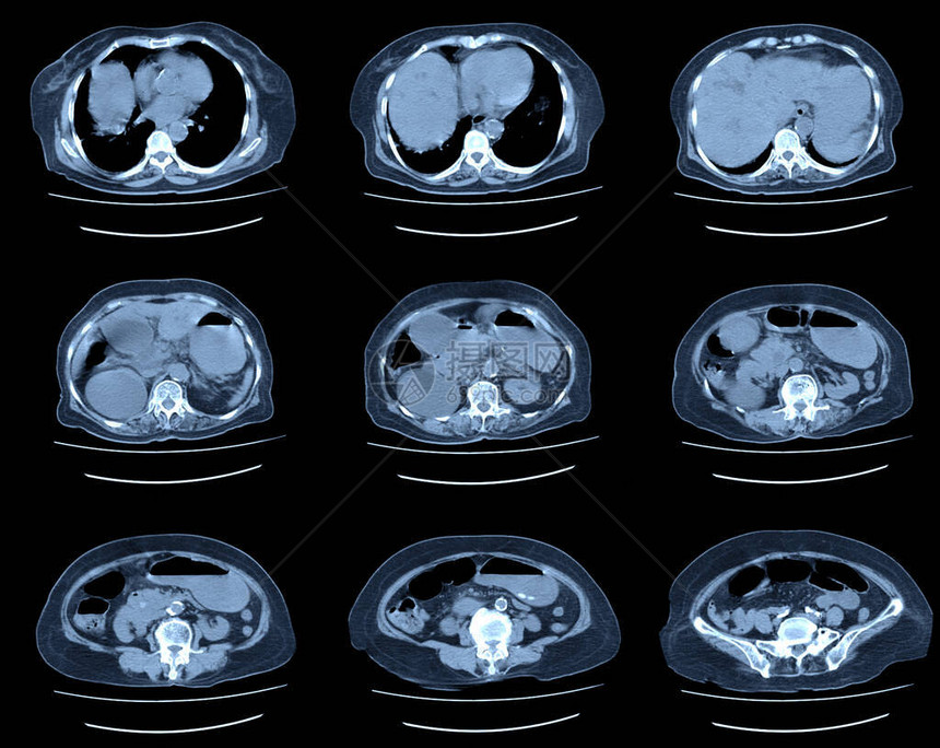 通过MRI扫描腹部进行腹部CT扫描图片