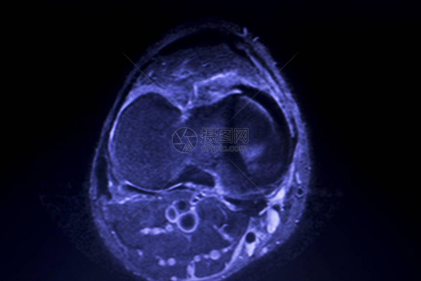 磁共振成像MRI膝盖后部角中枢断裂的眼泪图片