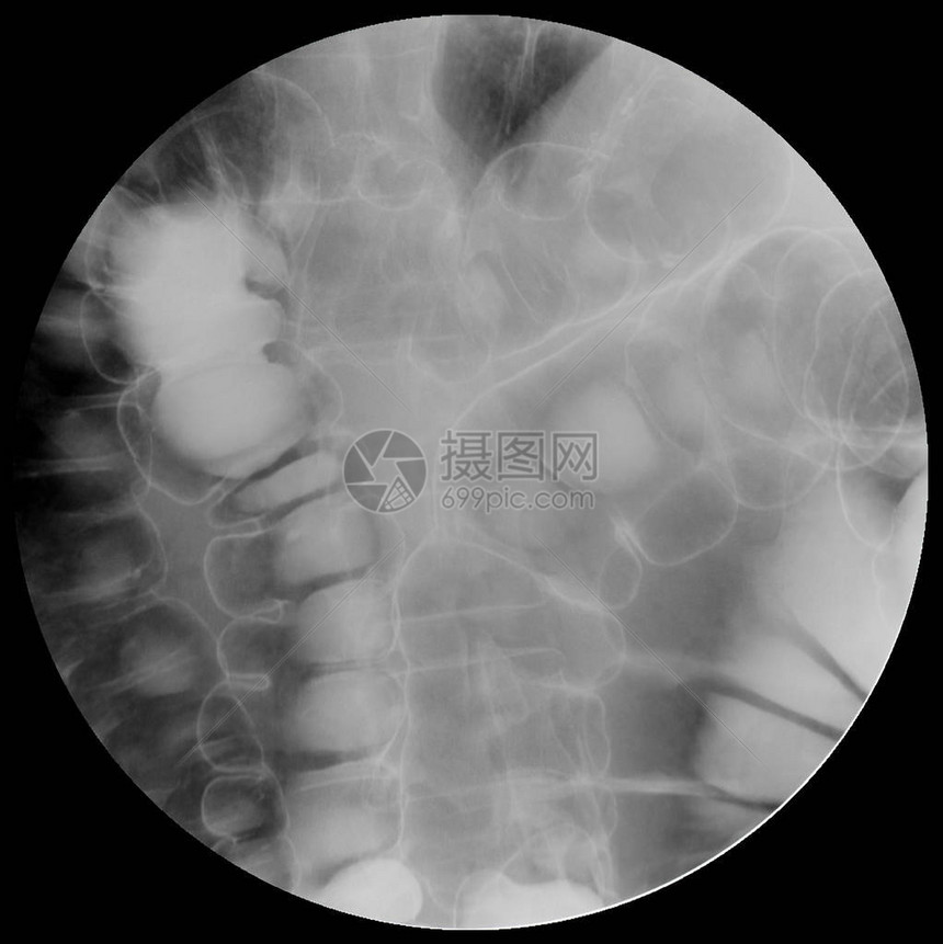大肠或结肠的钡灌肠图像或X射线图像显示大肠和阑尾的解剖结构图片