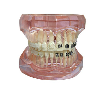 白底牙齿上有金属和塑料牙套的孤立下巴模型通过透明材料可见的牙根图片