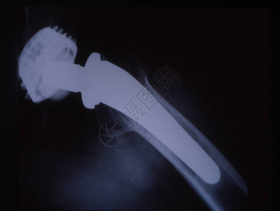 人大腿X光图像中的图片