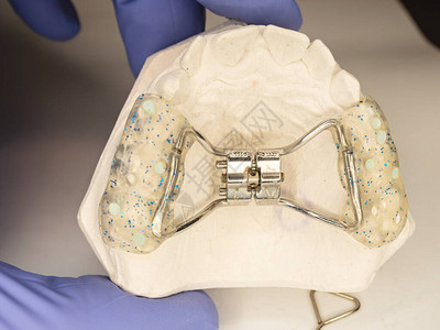 Hyrax牙套佩戴在患者牙齿石膏模型上在将其放在患者上颚之前图片