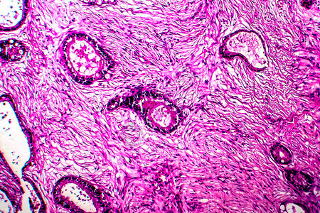 子宫癌轻显微镜显背景图片