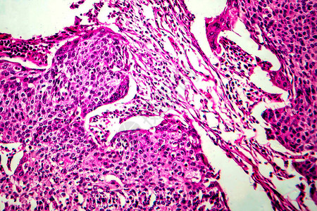 子宫基细胞癌光显微镜显图片