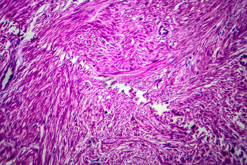 是良子宫滑动肌肉肿瘤光显微镜显图片
