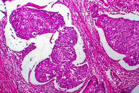 子宫基细胞癌光显微镜显图片