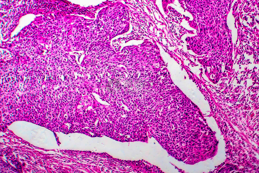子宫基细胞癌光显微镜显图片