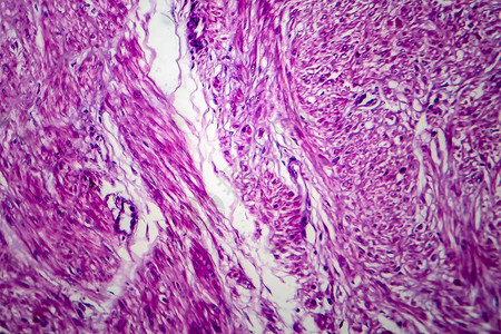 是良子宫滑动肌肉肿瘤光显微镜显背景图片