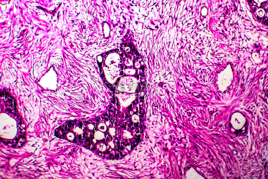 子宫癌轻显微镜显图片