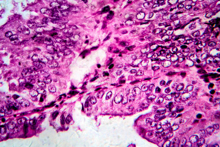 子宫内膜腺癌图片