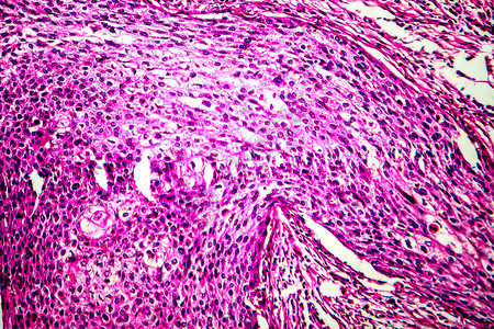 子宫基细胞癌光显微镜显图片
