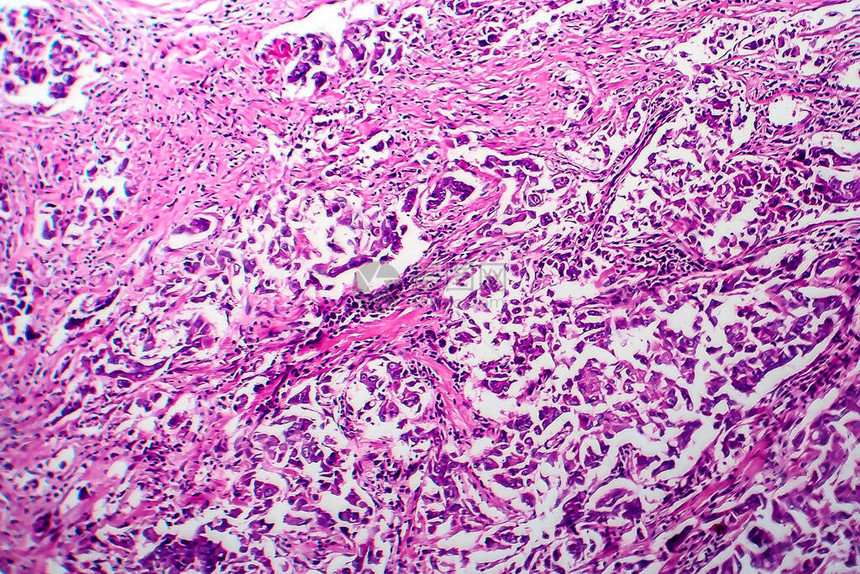 乳腺导管癌光学显微照片显微镜下的照片图片