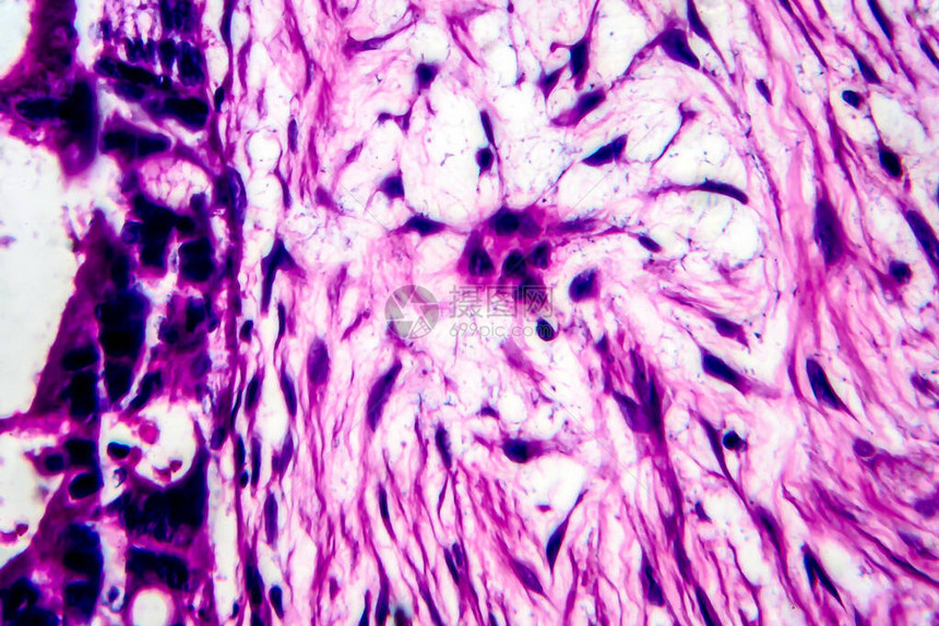 子宫癌轻显微镜显图片