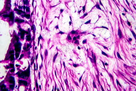 子宫癌轻显微镜显高清图片