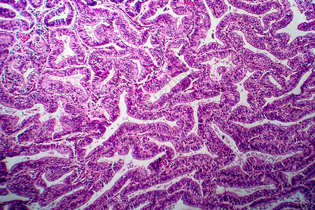 子宫内膜腺癌图片