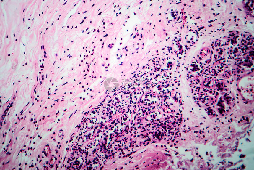 乳腺细胞纤维化轻显微镜显微镜下照片图片