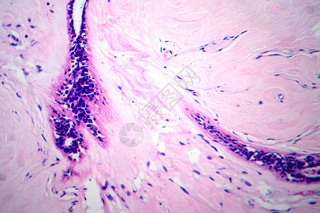 子宫腺纤维瘤高清图片