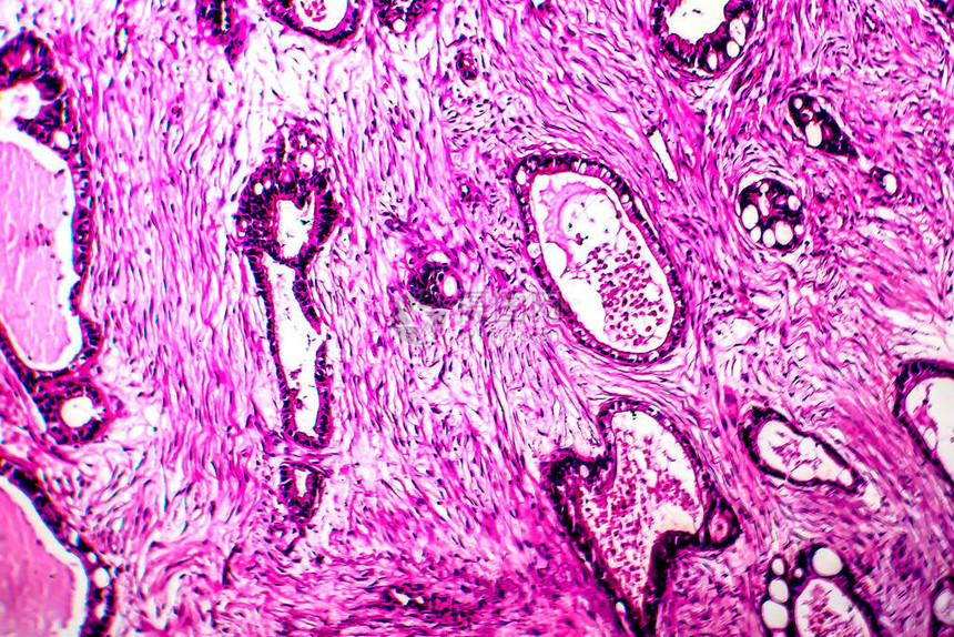子宫癌轻显微镜显图片
