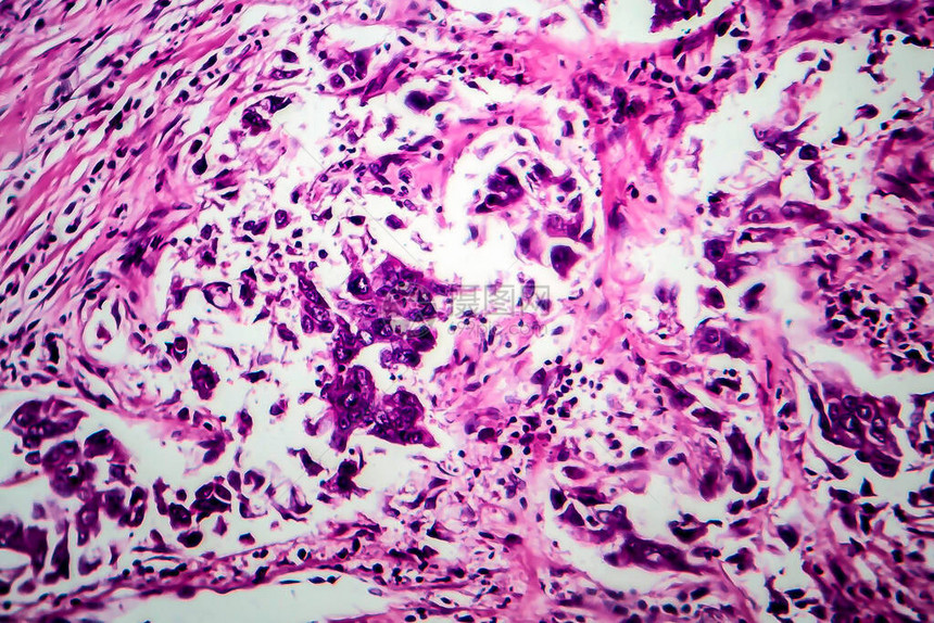 乳腺导管癌光学显微照片显微镜下的照片图片