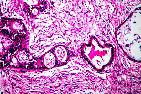 子宫癌轻显微镜显背景图片