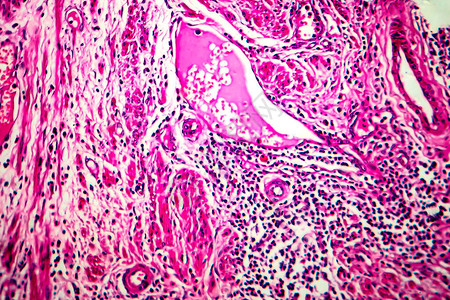 子宫基细胞癌光显微镜显背景图片