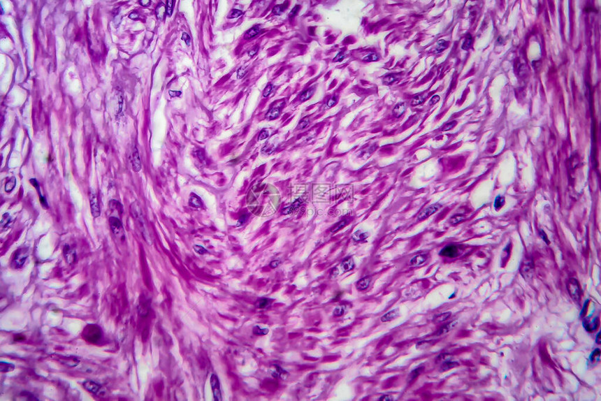 是良子宫滑动肌肉肿瘤光显微镜显图片
