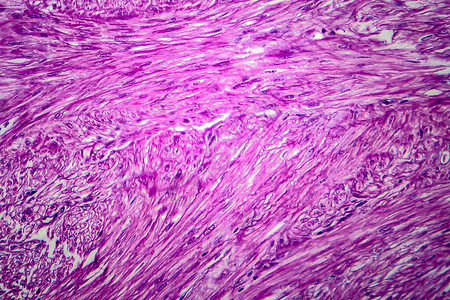 是良子宫滑动肌肉肿瘤光显微镜显图片