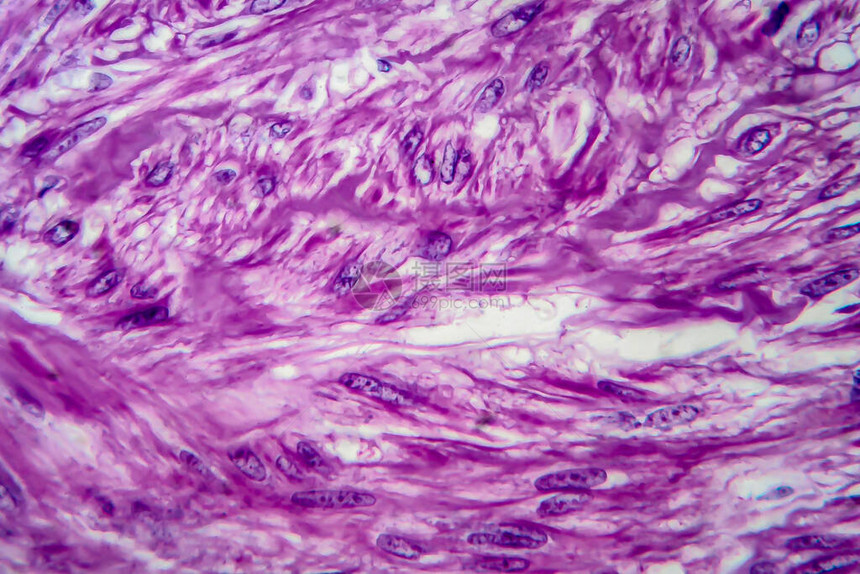 是良子宫滑动肌肉肿瘤光显微镜显图片