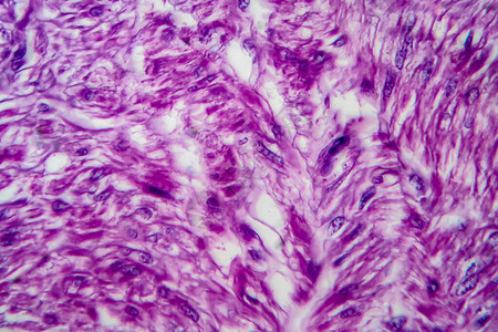 是良子宫滑动肌肉肿瘤光显微镜显背景图片