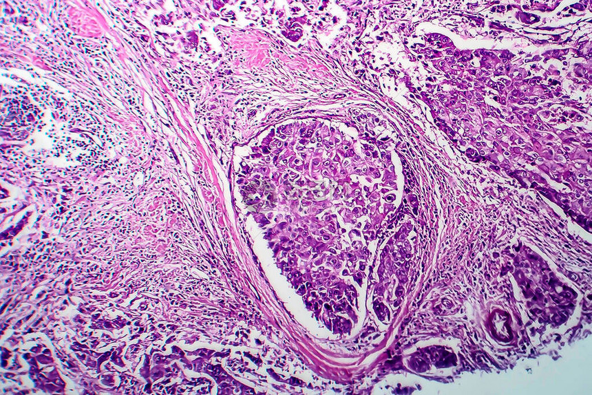 乳腺导管癌光学显微照片显微镜下的照片图片