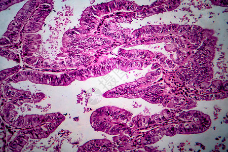 子宫内膜腺癌图片