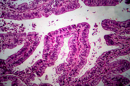 子宫内膜腺癌背景图片