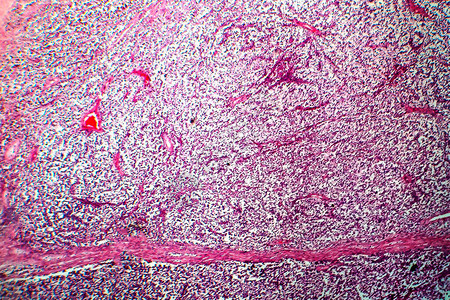 睾丸精原细胞瘤高清图片