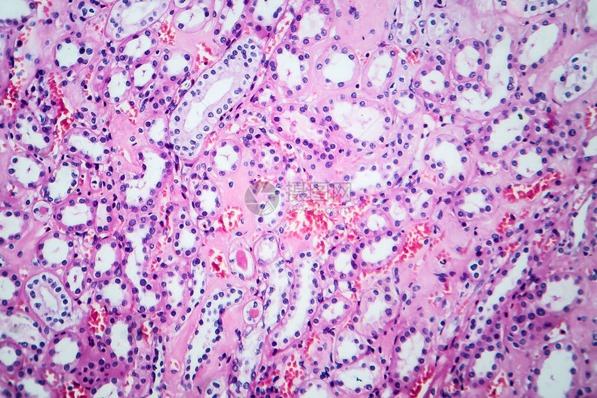 高血压肾脏病光显微摄影显微镜下照片图片