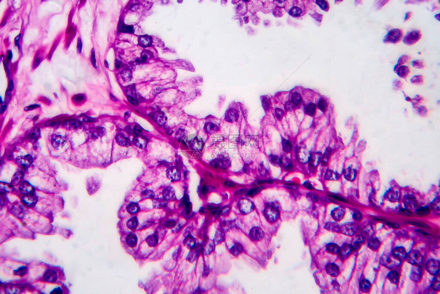 前列腺癌轻显微镜显图片