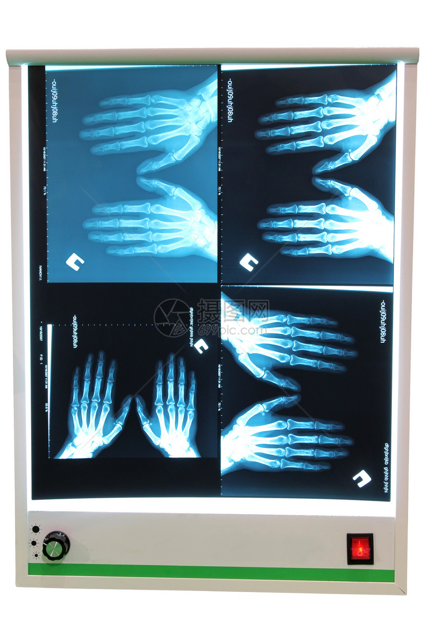 X射线照片和增感屏图片