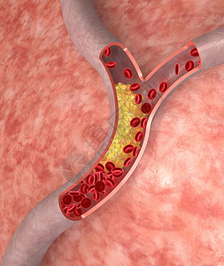 动脉中的胆固醇斑块医学概念图片