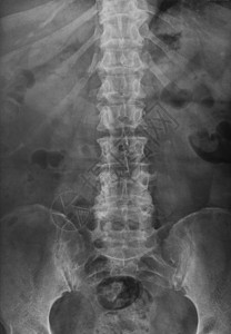 骨盆和脊柱的X射线图片