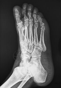人体足部受伤X光片图图片