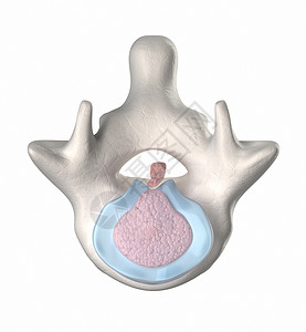 椎间盘退变SEQUESTRATION图片