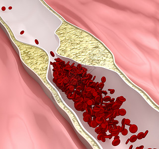 缺血硬化病阻止血图片