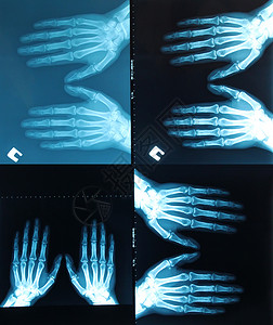 X射线照片图片